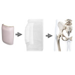 Hip Protectors - Standard Packs